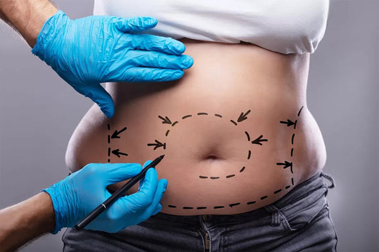 Liposuction Process: A Quick Overview